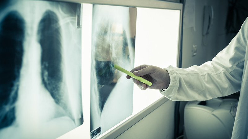 Lung X-rays being studied by a clinician