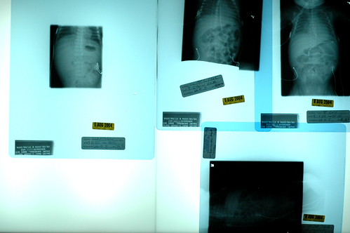 day 35: lots of x-rays. | by snowdeal