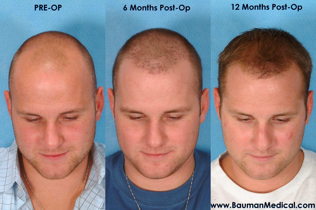 Hair Transplant Before & After_AG12_02 | Patient 