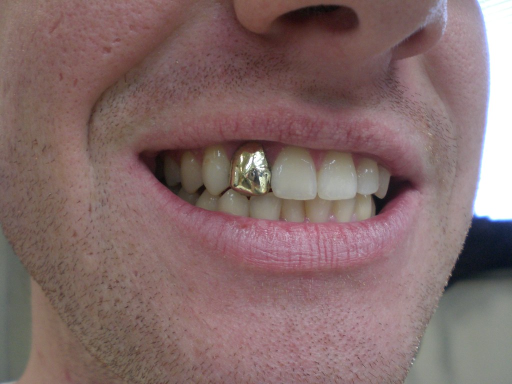 Gold tooth | I won this in a fight. | templedmdstudent | Flickr