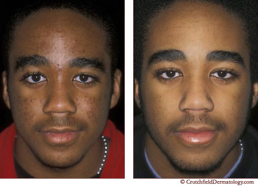 Acne Laser Treatment On Dark Skinned Teenager Before Af Flickr