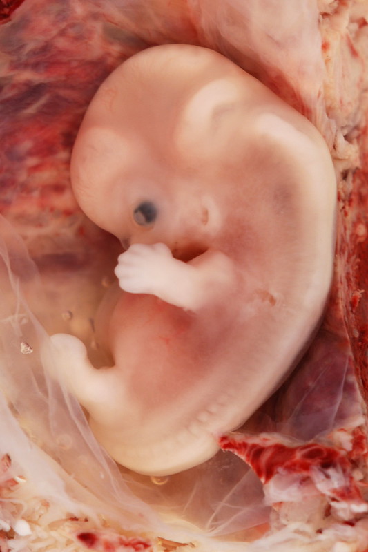 9-Week Human Embryo from Ectopic Pregnancy