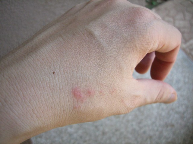 Bed bug bite first day