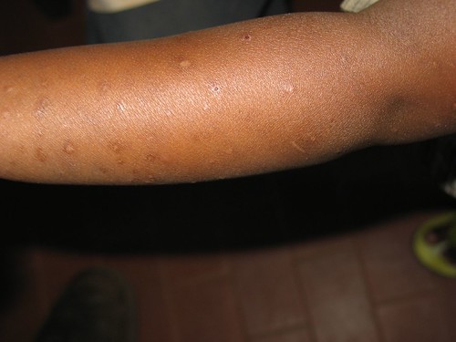 Rash in Child with HIV (1) | This is the most common rash we… | Flickr