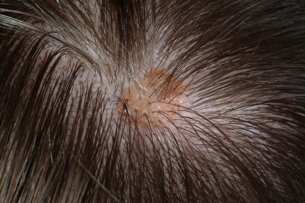 Seborrheic Keratosis | Brown warty lesion of the scalp. | EncinoMan ...