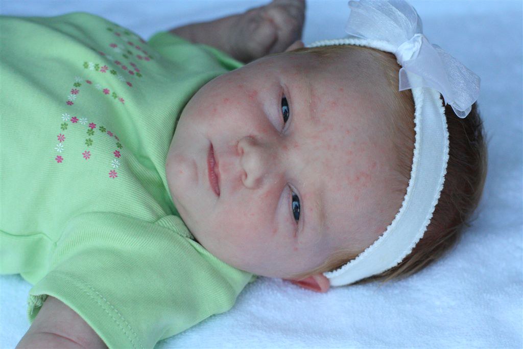 Flickr Bebe Rash Blessing rash | Viv is beautiful, even with her sad little r… | Flickr