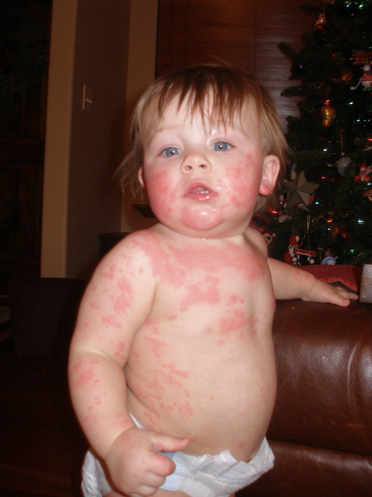 Flickr Bebe Rash 2006 December | Flickr