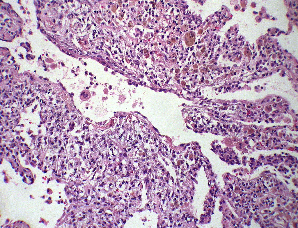 Langerhans cell histiocytosis
