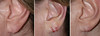 earlobe-repair-1-027 8
