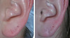 earlobe-repair-1-021 2