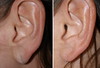earlobe-reduction-1-009 8