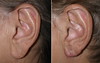 earlobe-reduction-1-011 10
