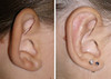 protruding-ears-1-046 9