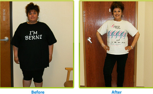 Before and after weight loss surgery | by jackiebese
