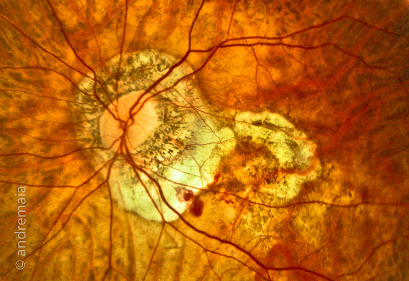 Alta myopia retina Cineva și-a îmbunătățit vederea