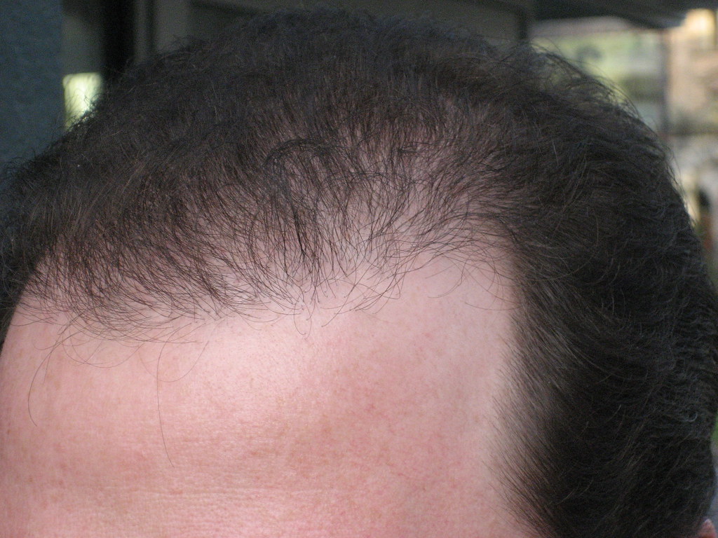 202 Days After Bosley Hair Restoration Procedure | Follow my… | Flickr