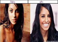 Total Plastic Surgery Brings Collien Fernandes Additional Allure On Her Face After Surgery