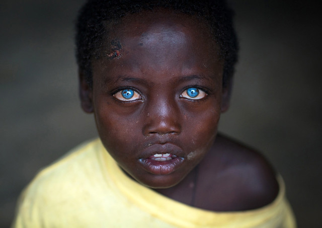 Ethiopian boy called Abushe with blue eyes suffering from waardenburg syndrome, Omo valley, Jinka, Ethiopia