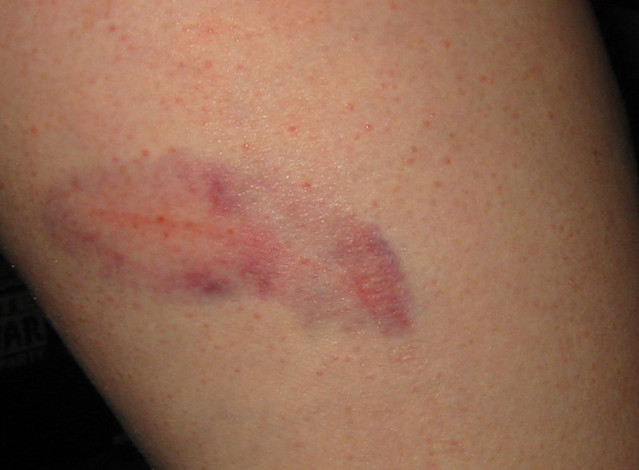 20060602 - 100-0096 - Carolyn's bruise