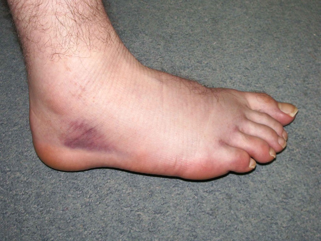 Broken_Foot_Sideview - Yeah, I broke my foot the other day. … - Flickr