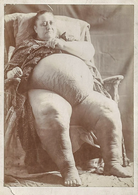 Cabinet card of a woman with an engorged stomach