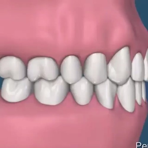 Implante dental é a melhor maneira pra recuperar dentes perdidos e reabilitar a estética e a mordida. A falta de dentes pode levar a um colapso oclusal e mais perdas dentárias. #dentalimplants #extraction #implantation #implant #oralsurgery #dentistry #od | by RafaelBT