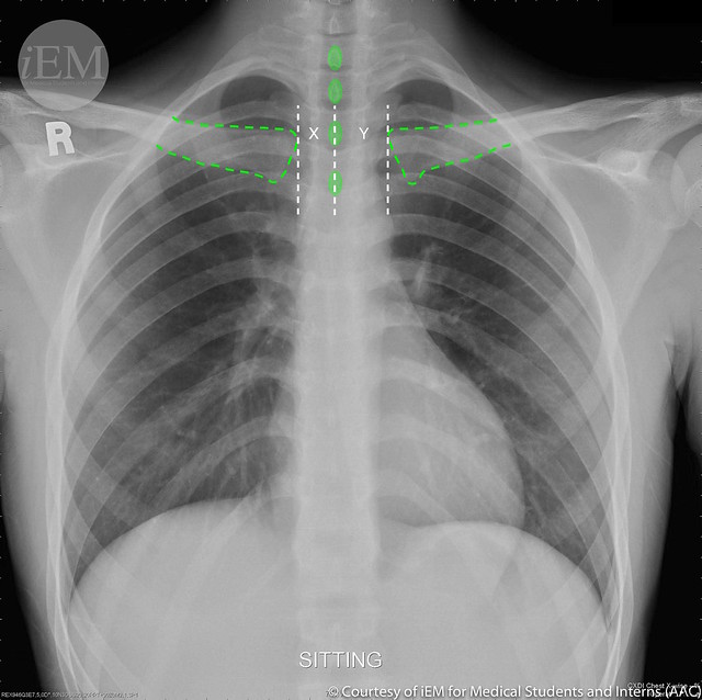 336.1 -  PA chest x-ray - Rotation