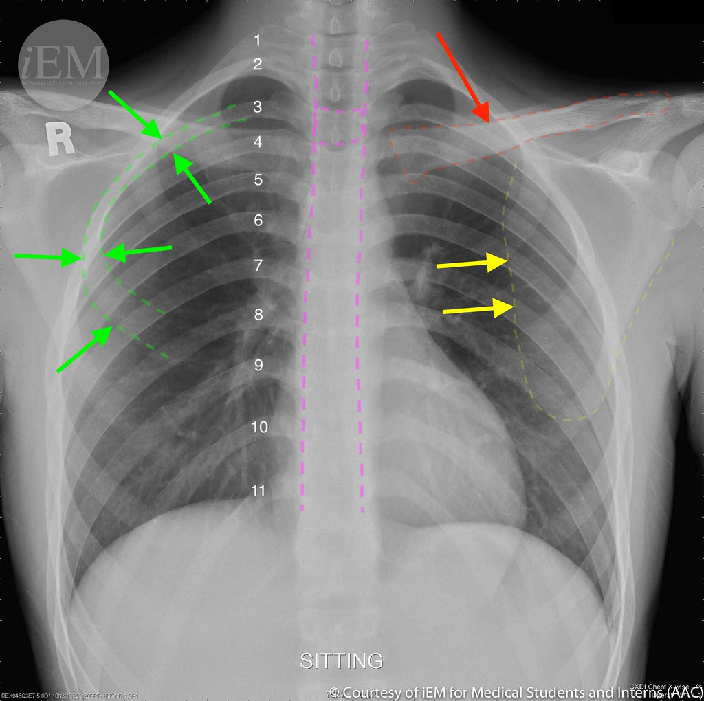 336.4 - normal PA chest x-ray - BONY STRUCTURES | Figure-9: … | Flickr