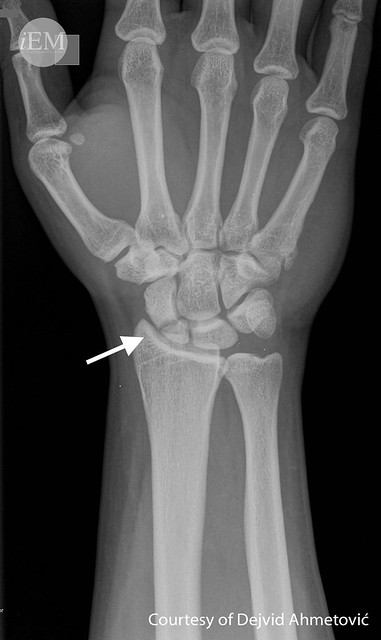 87 - Figure 6 - Fracture of the proximal pole of the scaphoid