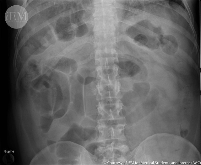 331.2 - small bowel obstruction - supine