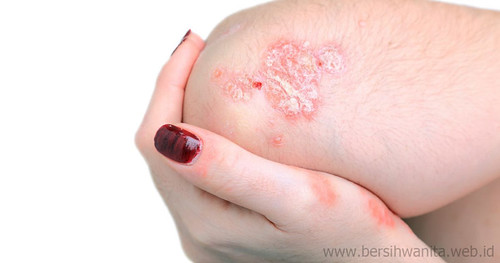 Harga Obat Psoriasis di Apotik Resep Dokter | Harga Obat ...
