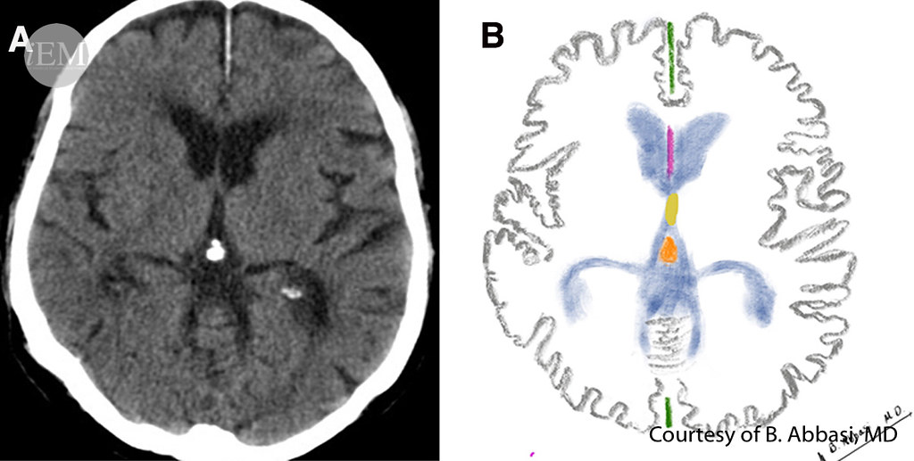 627.2 - Figure - 02 - Axial brain CT scan