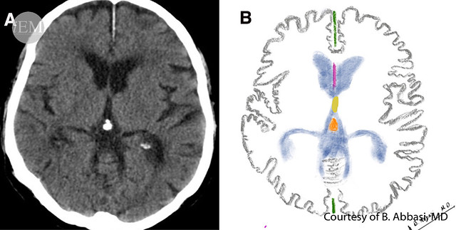 627.2 - Figure - 02 - Axial brain CT scan