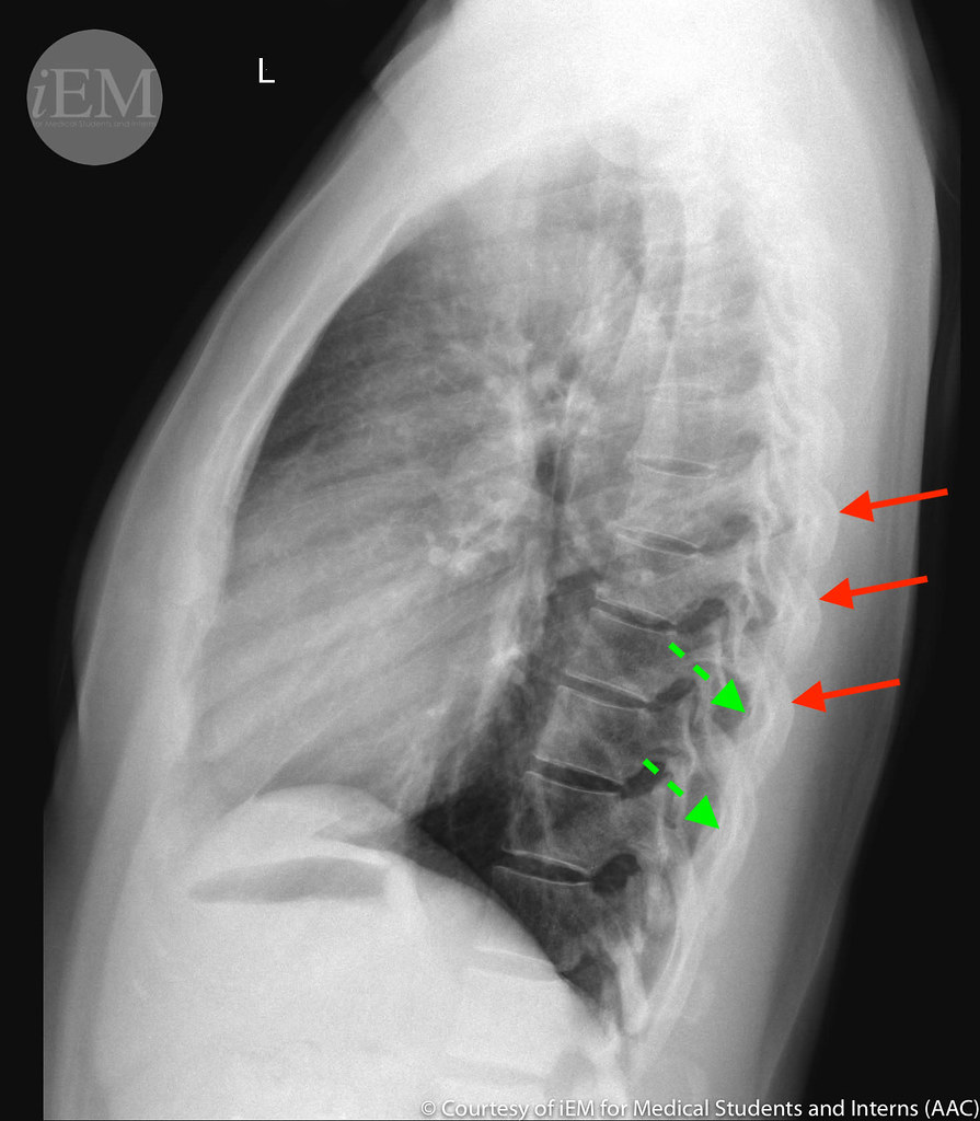 337.3 - normal lateral chest x-ray showing right and left … | Flickr