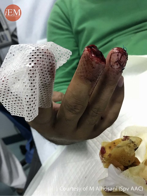 723 - finger tip amputation