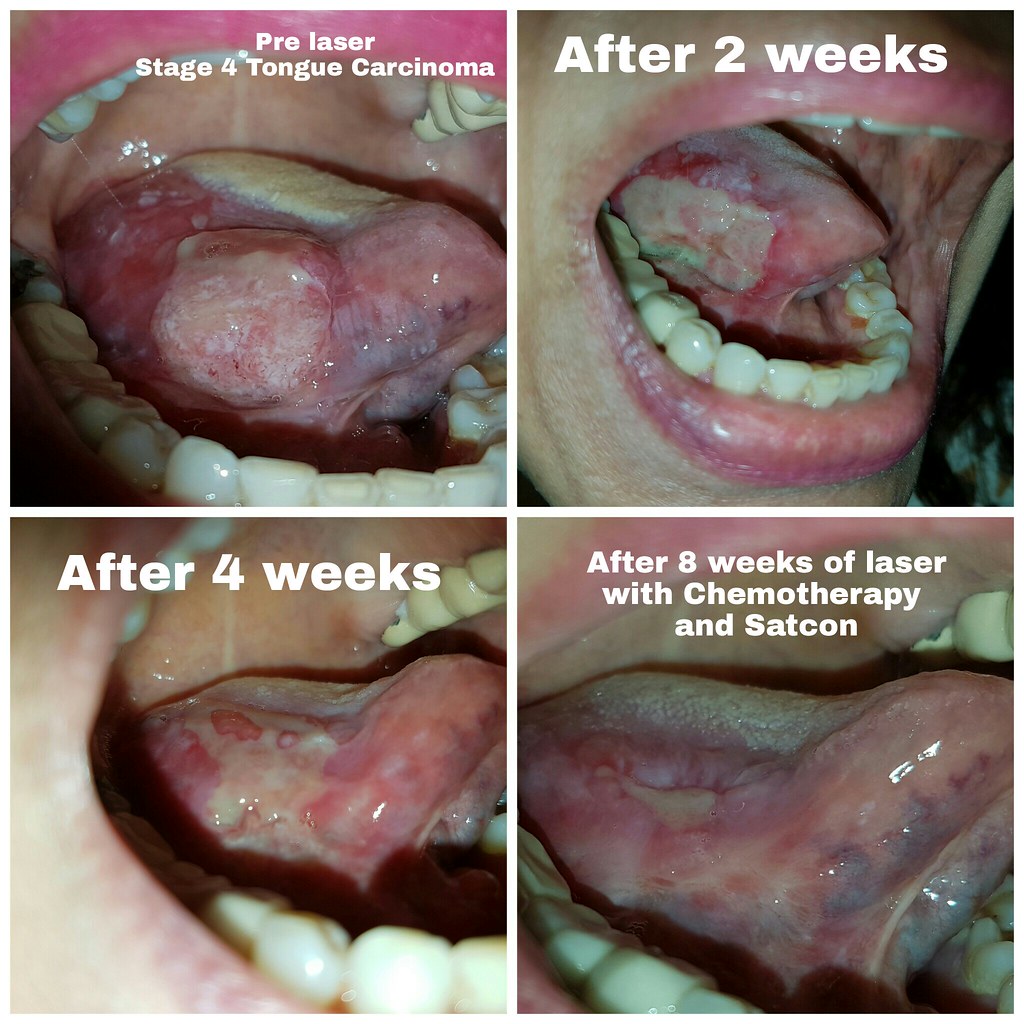Squamous Cell Carcinoma Tongue Stage 1