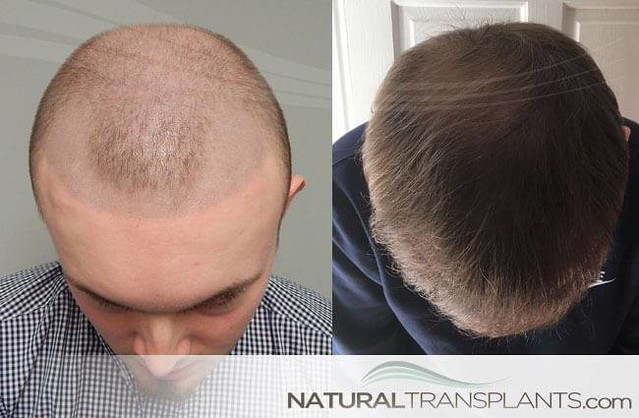 hair-doctor-near-me | hair doctor near me | Natural Transplants Hair  Restoration Clinic | Flickr
