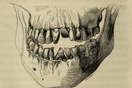 This image is taken from Page 180 of Nouveau traitÃ© thÃ©orique et practique de lart du dentiste : avec cent trente figures sur bois gravÃ©es par Badoureau