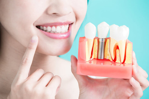 Tooth implant Torrance | by Omni Dental Art