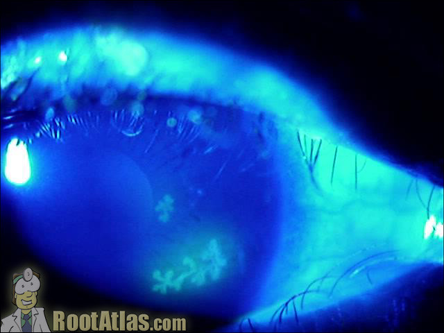 Herpetic ocular disease