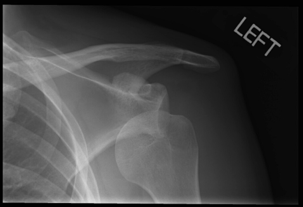 X-Ray showing a left shoulder dislocation