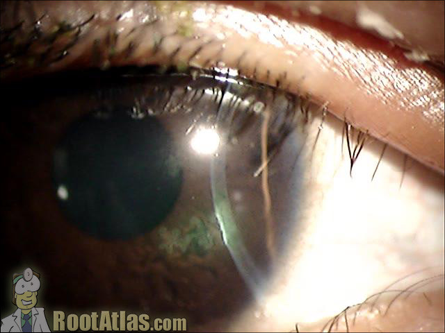 HSV dendrites cornea (Ophthalmology)