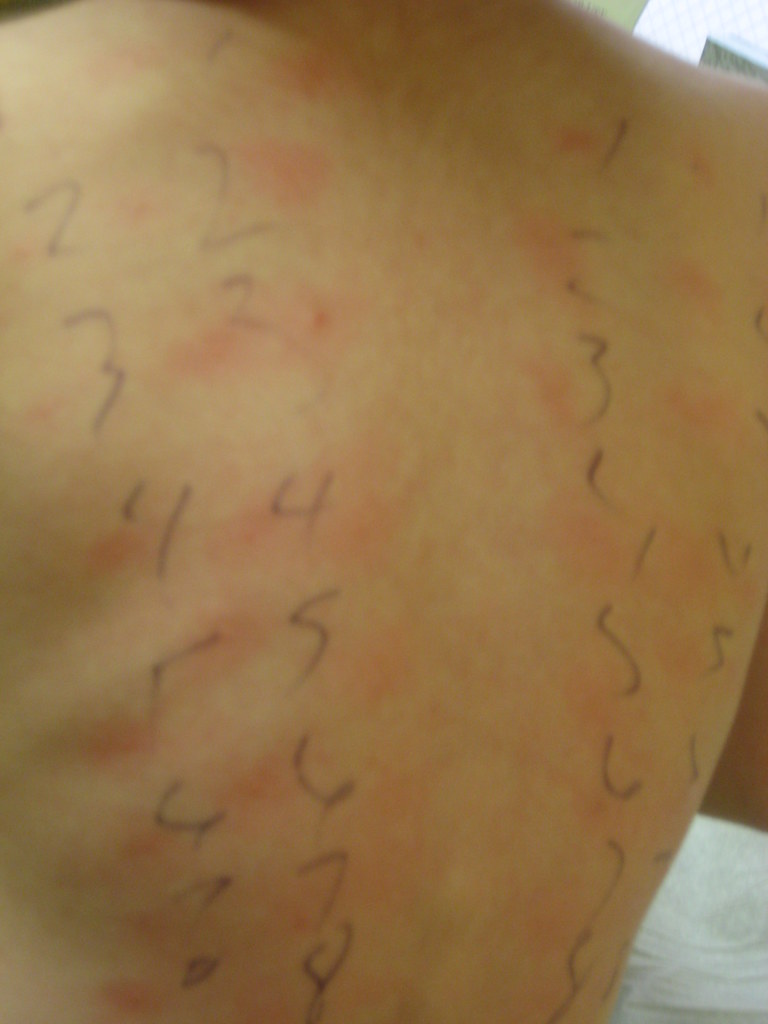Tree Pollen Rash Allergy testing | She's allergic to most trees, pollen, mold ...