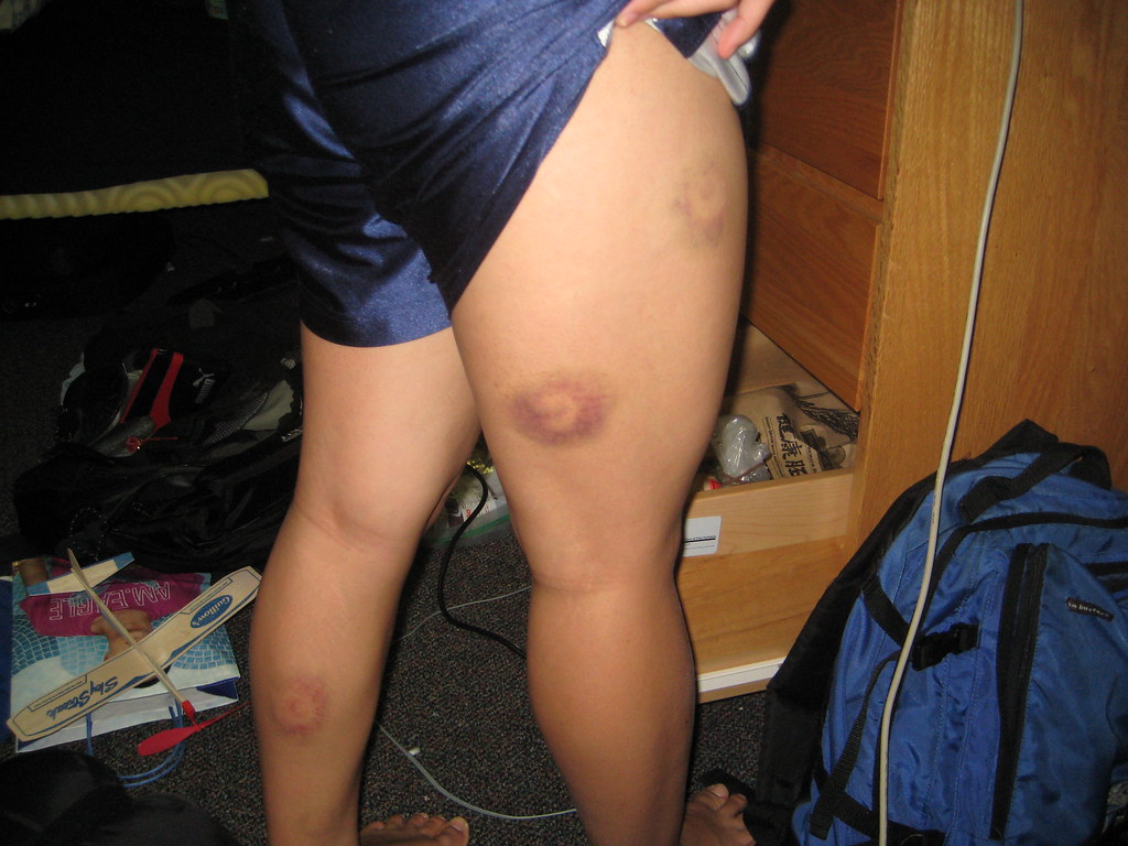 Paintball wounds, Welts/bruises from paintball. The one on …