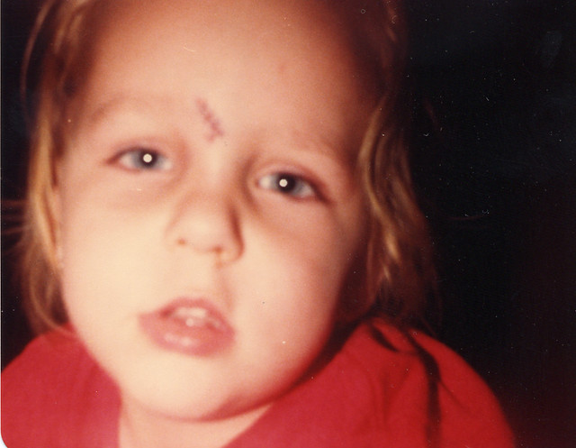 Stiches at 2.5 Years Old