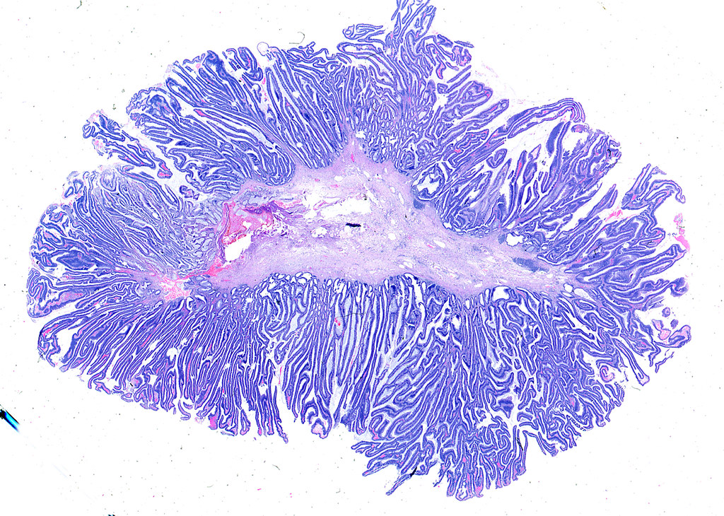 Rectal Adenocarcinoma Arising in Villous Adenoma (1) | Flickr