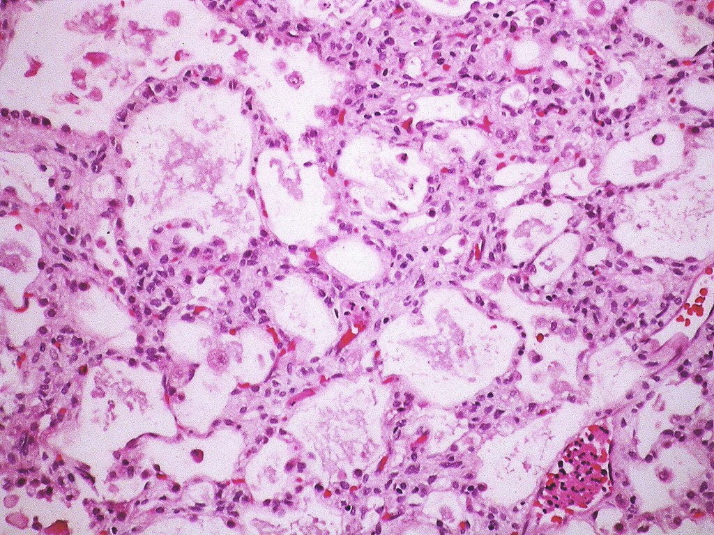 Alveolar adenoma  Case 182