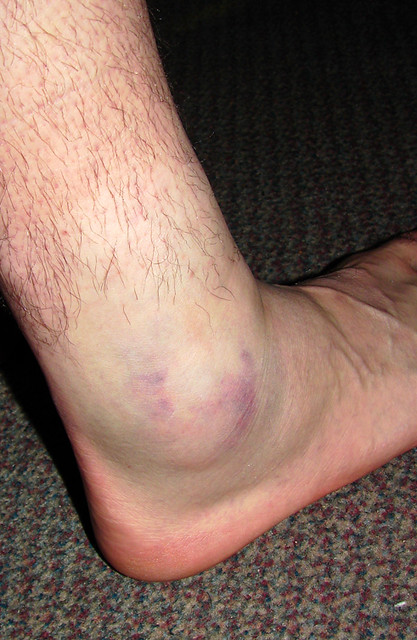 Attack of the Cankle!
