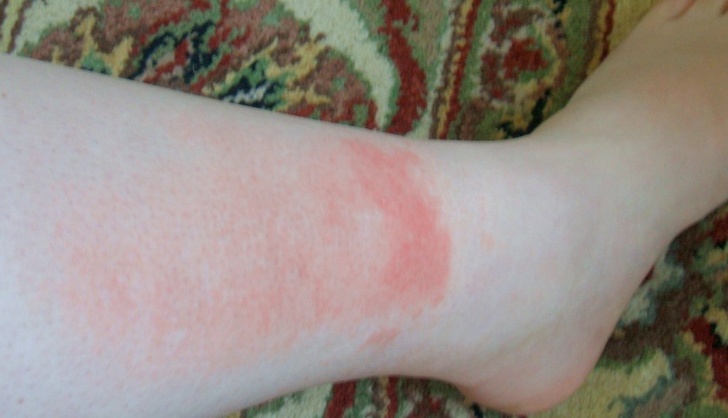 Golfer Rash Golfers Vasculitis