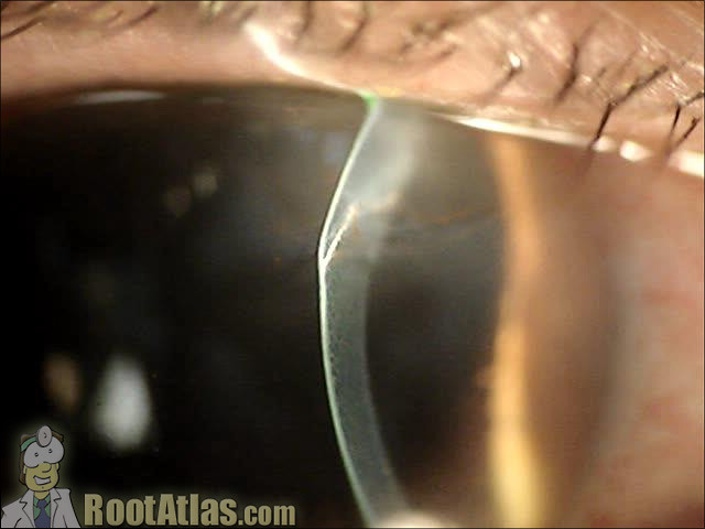 Ophthalmology - corneal laceration